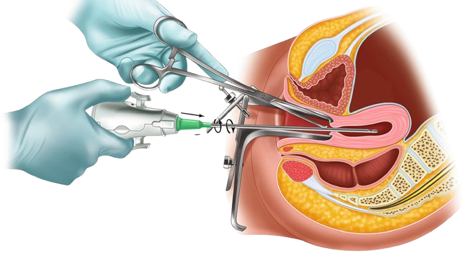 Spine Surgery