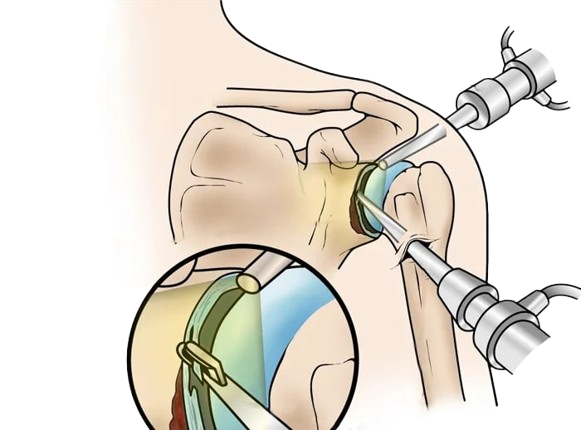 Spine Surgery